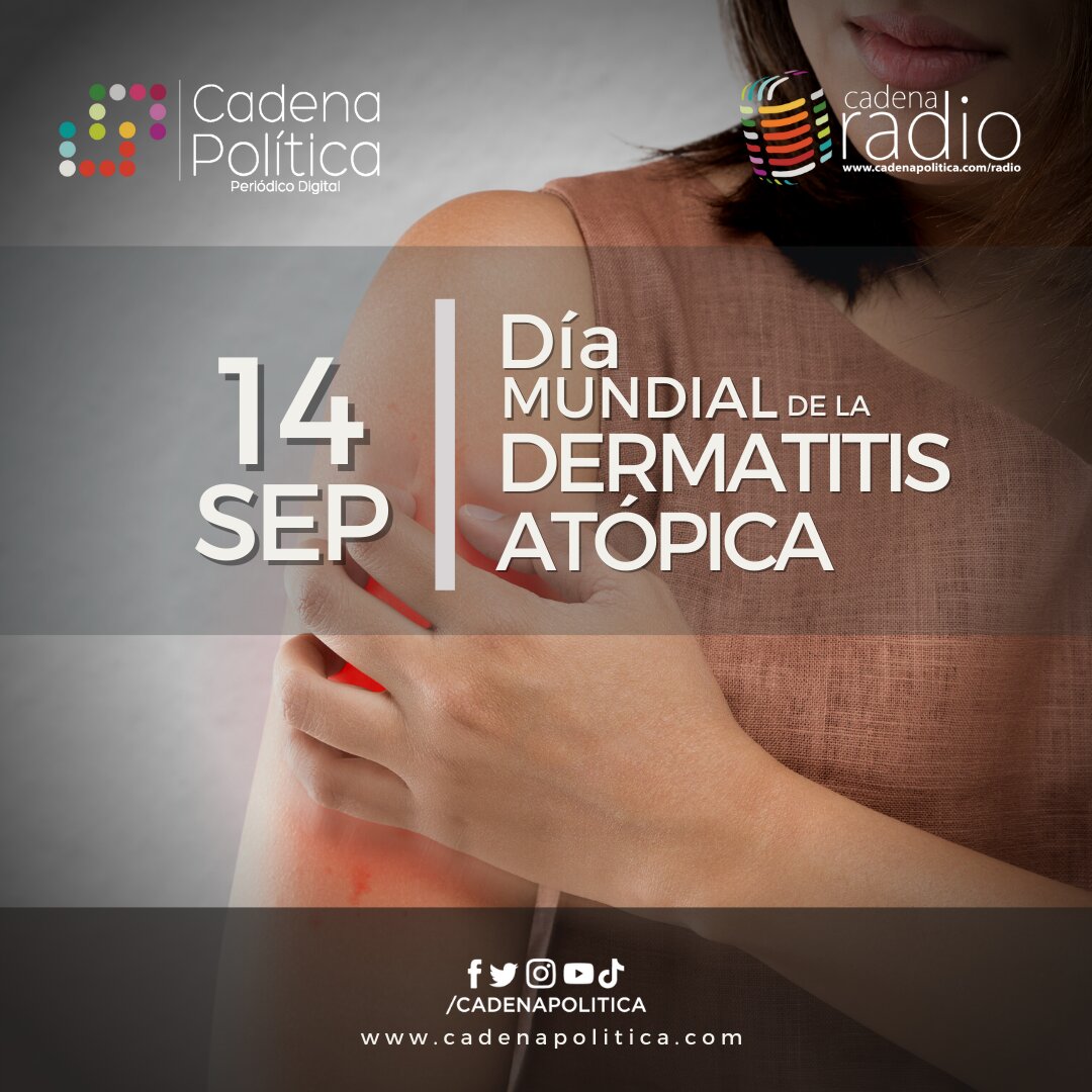 dermatitis atópica