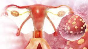 cancer ovario
