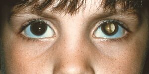 Cáncer ocular, retinoblastoma