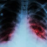 ¿Cómo saber si padeces Tuberculosis? ¡Chécate a tiempo!
