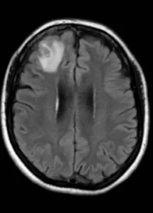 gusano-vivo-cerebro-mujer-australia-cerebro