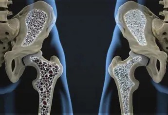 Mexicanos Padecen Osteoporosis