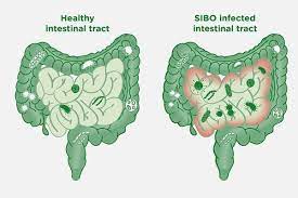 SIBO