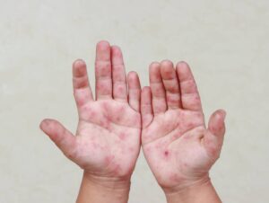 brote virus Coxsackie Puebla