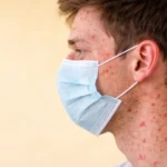 Emergencia epidemiológica: El brote de sarampión en México se dispara a 18 mil contagios y deja un saldo de 41 muertes