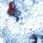 Secretaría de Salud Confirma Primer Caso de Cyclospora en Aguascalientes por Contagio Foráneo