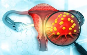 cáncer cervicouterino